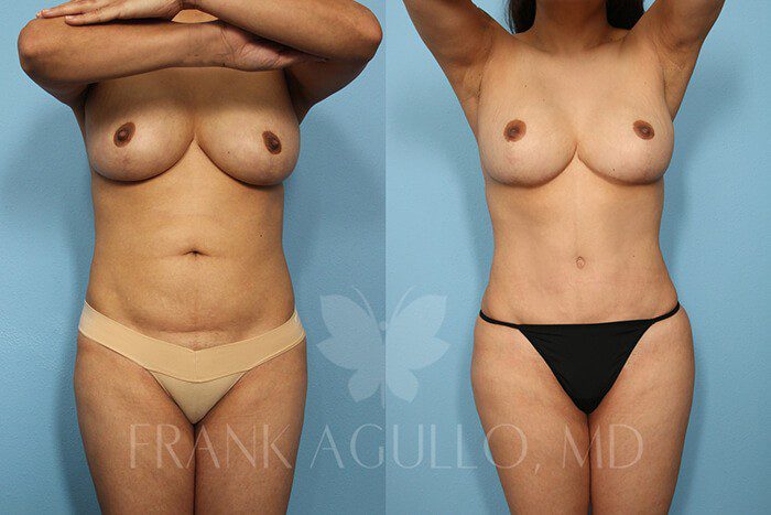 Tummy Tuck Before and After 7