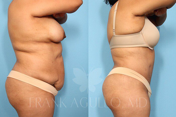Tummy Tuck Before and After 6