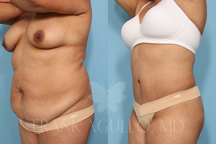 Tummy Tuck Before and After 5