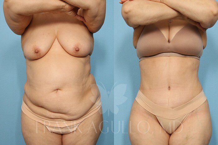 Tummy Tuck Before and After 4