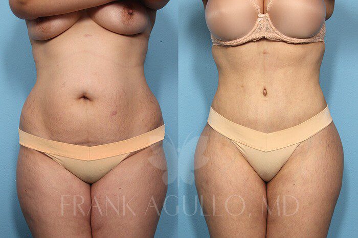 Tummy Tuck Before and After 3