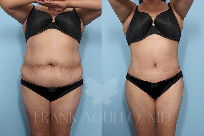 Tummy Tuck Before and After 2