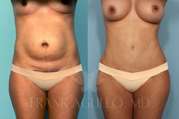 Tummy Tuck Before and After 1