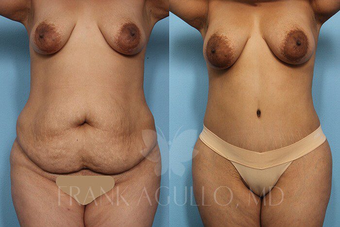 Tummy Tuck Before and After 20