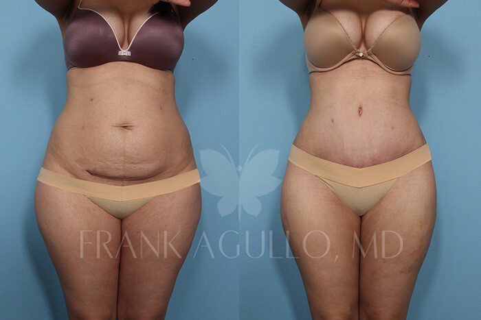 Tummy Tuck Before and After 19