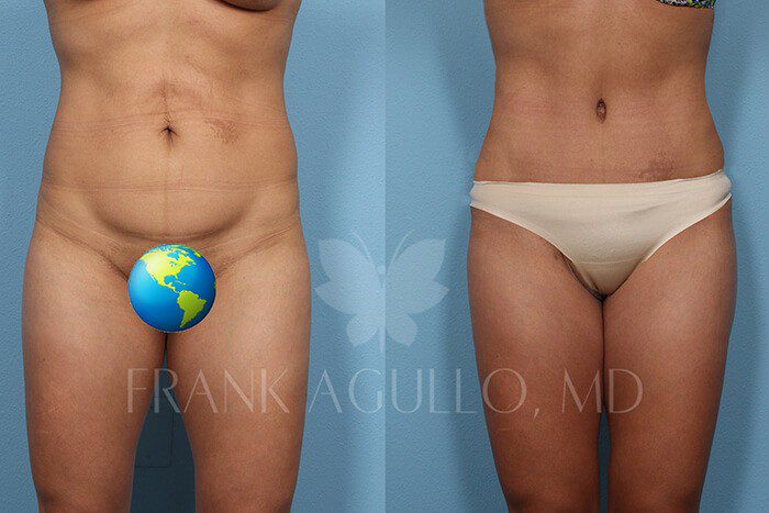 Tummy Tuck Before and After 18