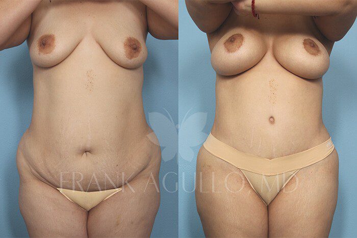 Tummy Tuck Before and After 17