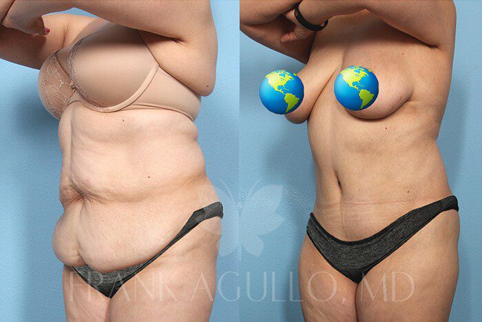 Tummy Tuck Before and After 14