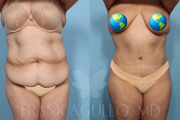 Tummy Tuck Before and After 13