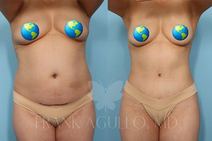 Tummy Tuck Before and After 12