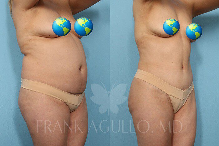 Tummy Tuck Before and After 2