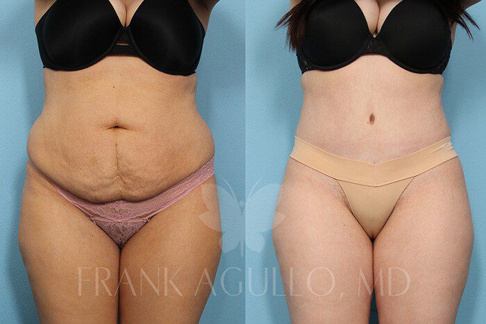 Tummy Tuck Before and After 11