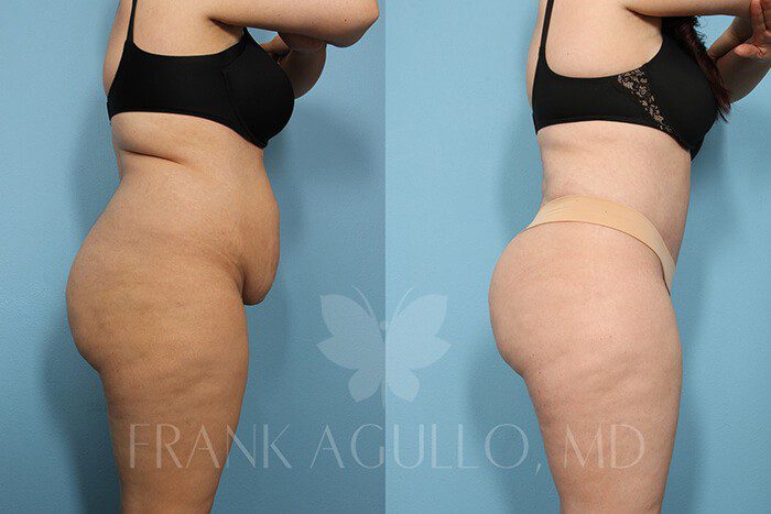 Tummy Tuck Before and After 3