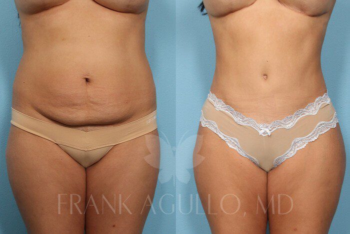 Tummy Tuck Before and After 9