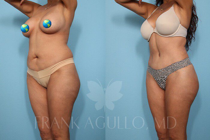 Tummy Tuck Before and After 8