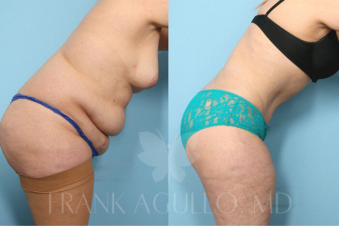 Tummy Tuck Before and After 7