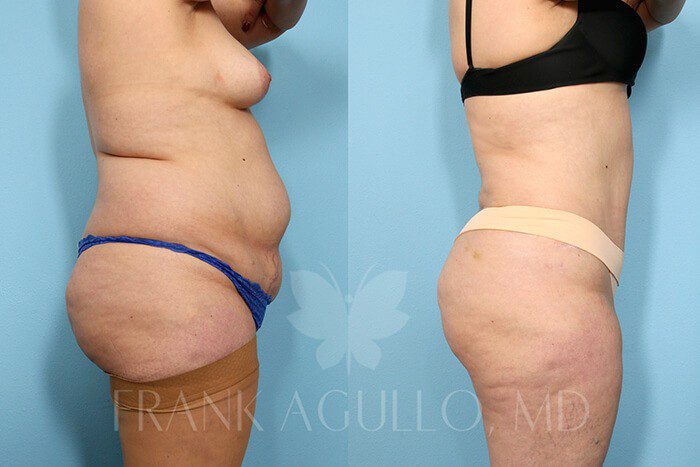 Tummy Tuck Before and After 2