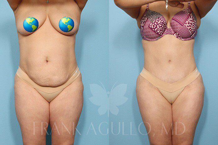 Tummy Tuck Before and After 6