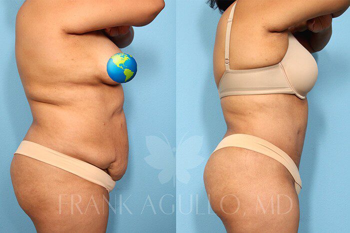 Tummy Tuck Before and After 5