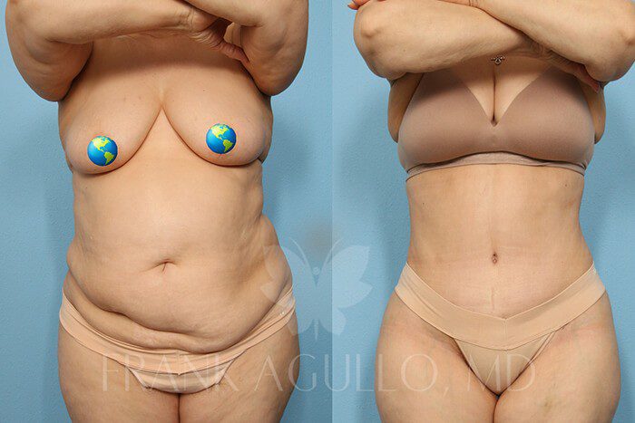 Tummy Tuck Before and After 4