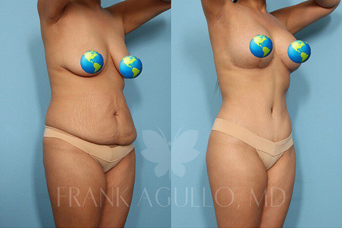 Tummy Tuck Before and After 3