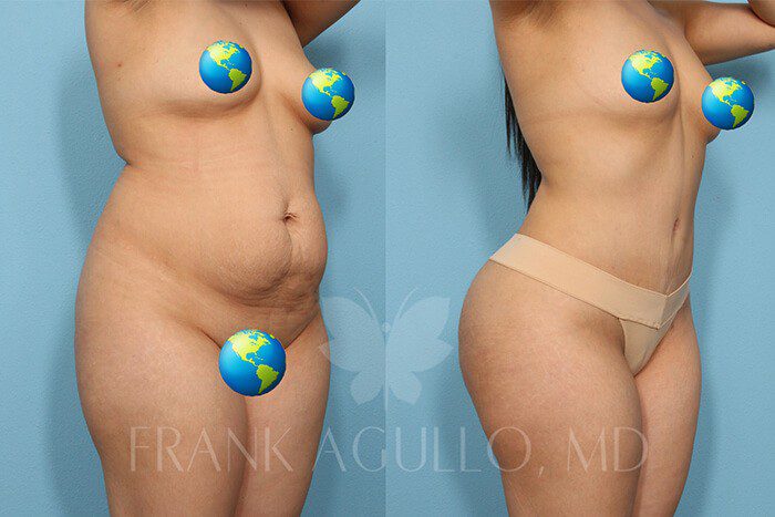 Tummy Tuck Before and After 2