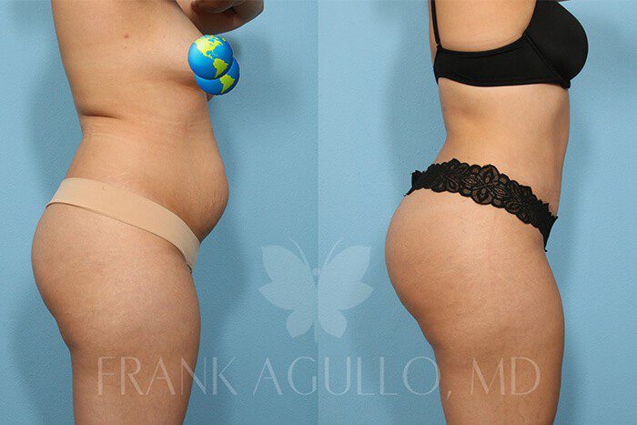 Tummy Tuck Before and After 1