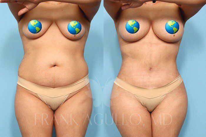 Tummy Tuck Before and After 20