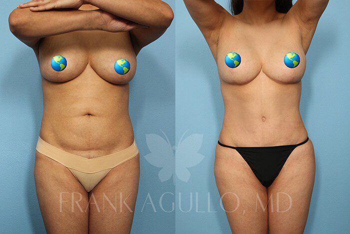 Tummy Tuck Before and After 19