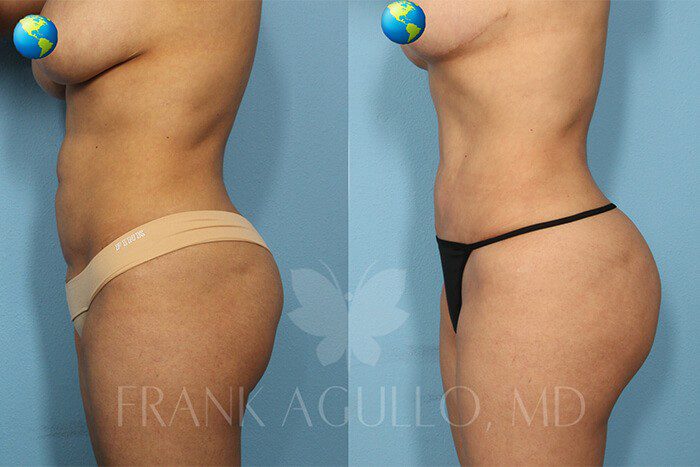 Tummy Tuck Before and After 2