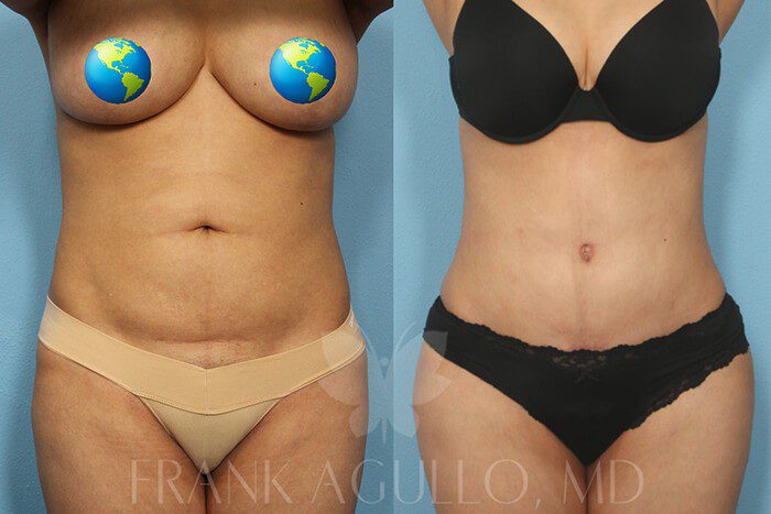 Tummy Tuck Before and After 18