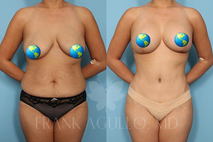 Tummy Tuck Before and After 17