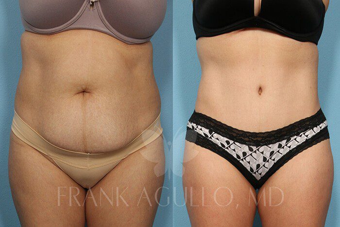 Tummy Tuck Before and After 15