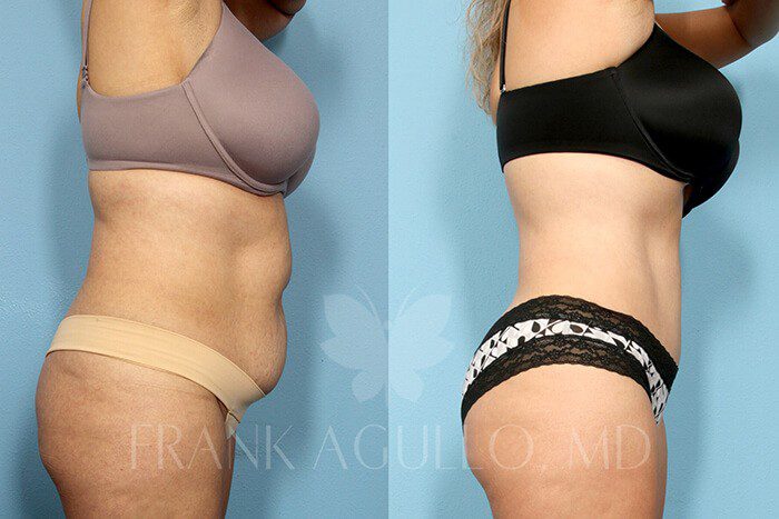 Tummy Tuck Before and After 2