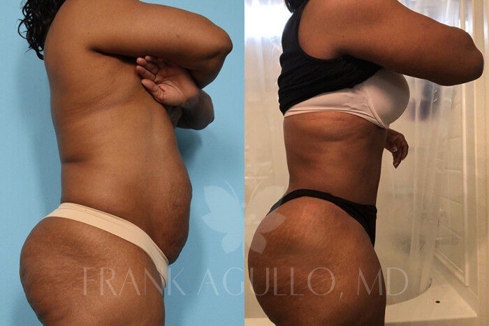 Tummy Tuck Before and After 14