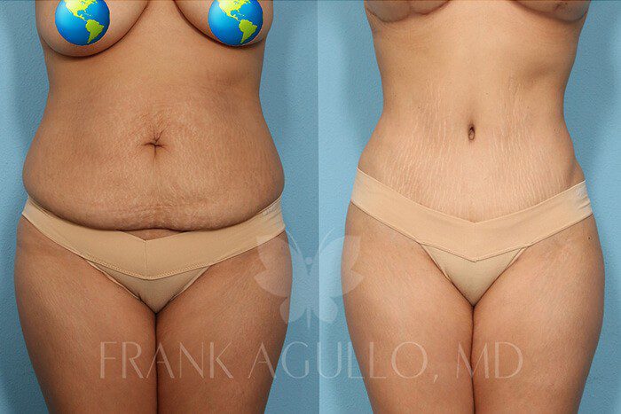 Am I a Candidate for a Tummy Tuck?