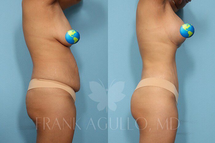 Tummy Tuck Before and After 2