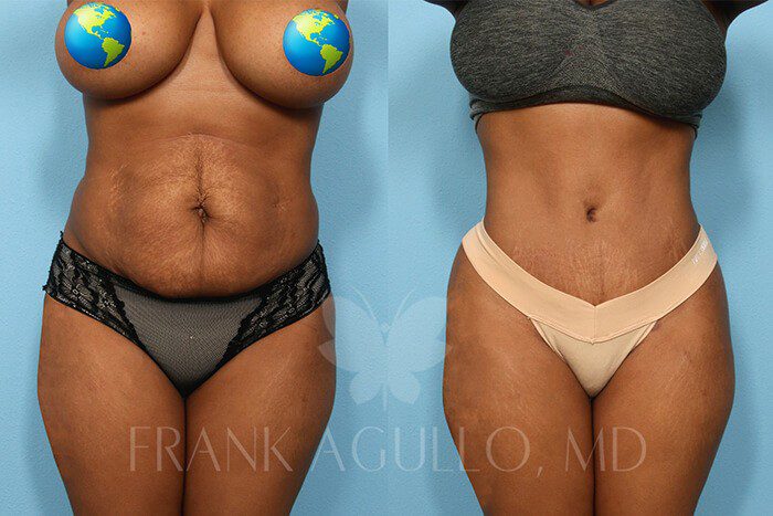 Tummy Tuck Before and After 12