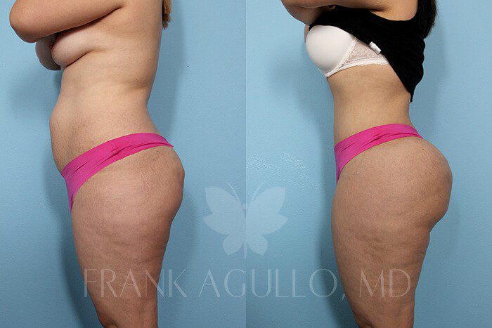 Tummy Tuck Before and After 11