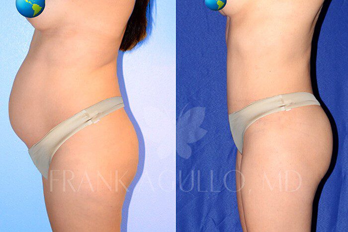 Tummy Tuck Before and After 10