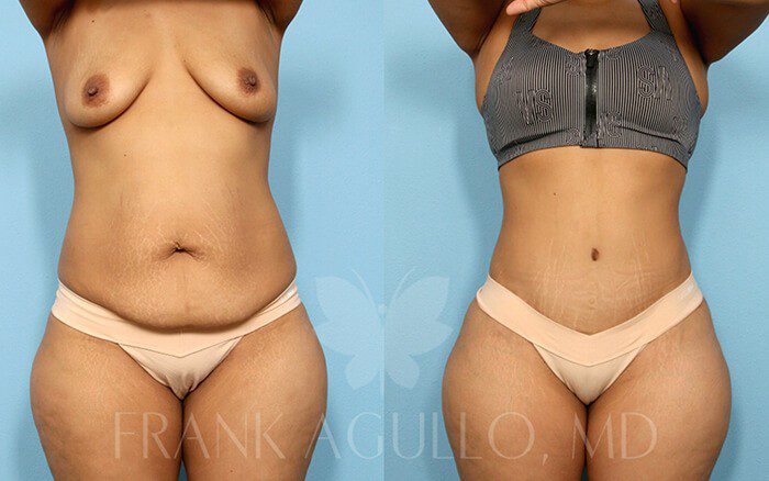 Tummy Tuck Before and After 9