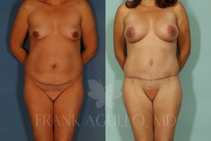 Tummy Tuck Before and After 12