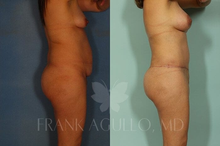 Tummy Tuck Before and After 2