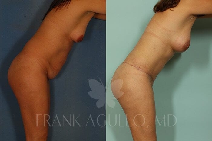 Tummy Tuck Before and After 3