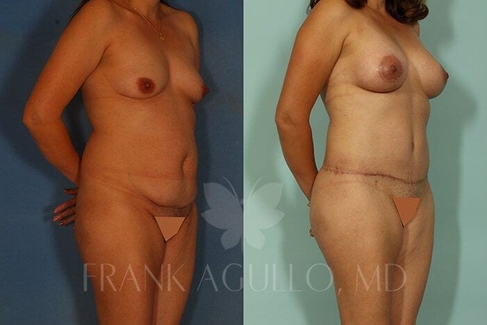 Tummy Tuck Before and After 4