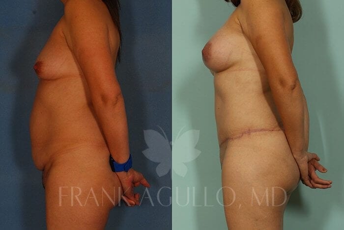 Tummy Tuck Before and After 5
