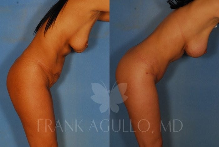 Tummy Tuck Before and After 3