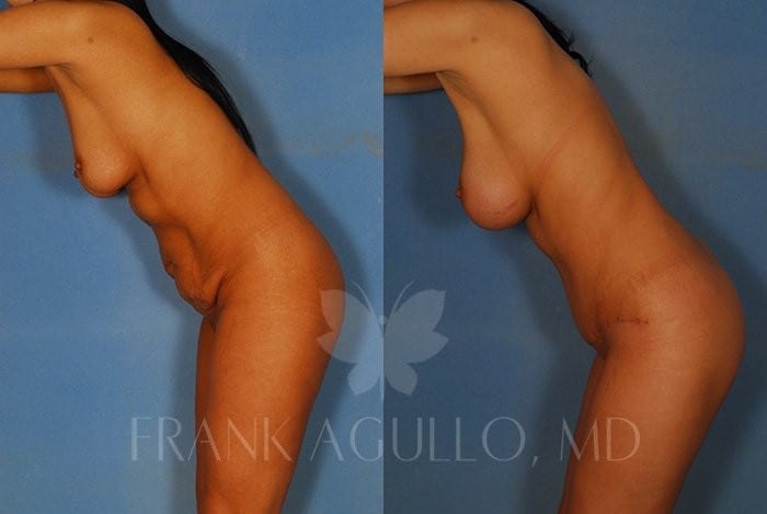 Tummy Tuck Before and After 2