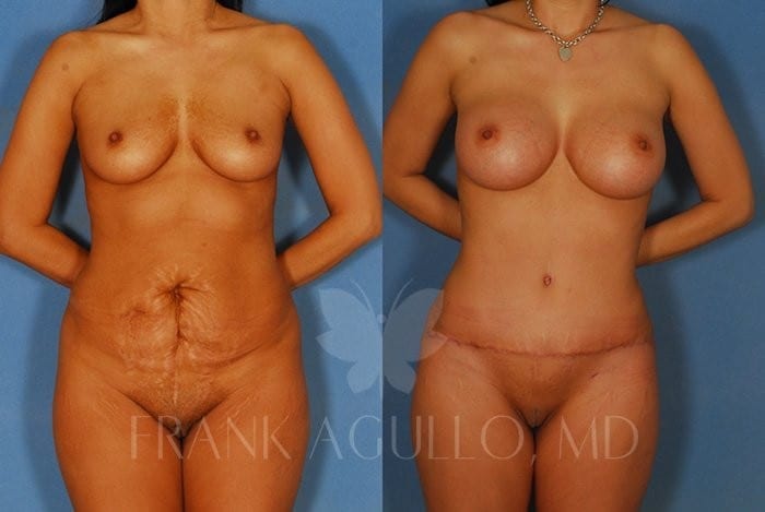 Tummy Tuck Before and After 3