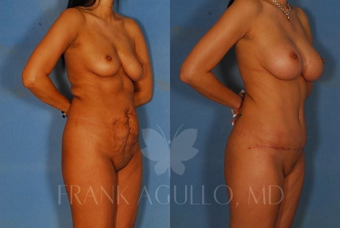 Tummy Tuck Before and After 5